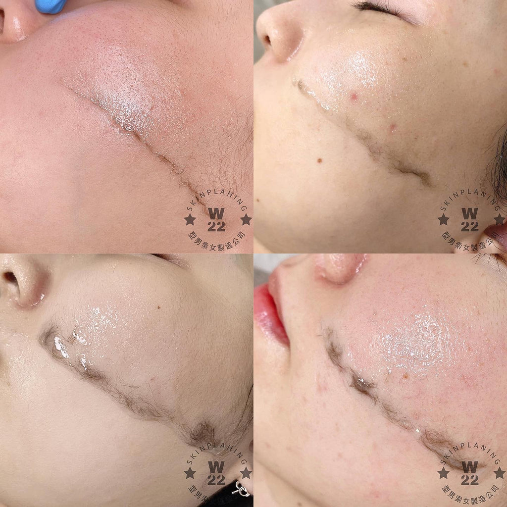 韓國Skinplaning拋光術