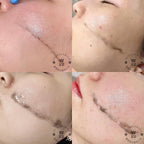 韓國Skinplaning拋光術